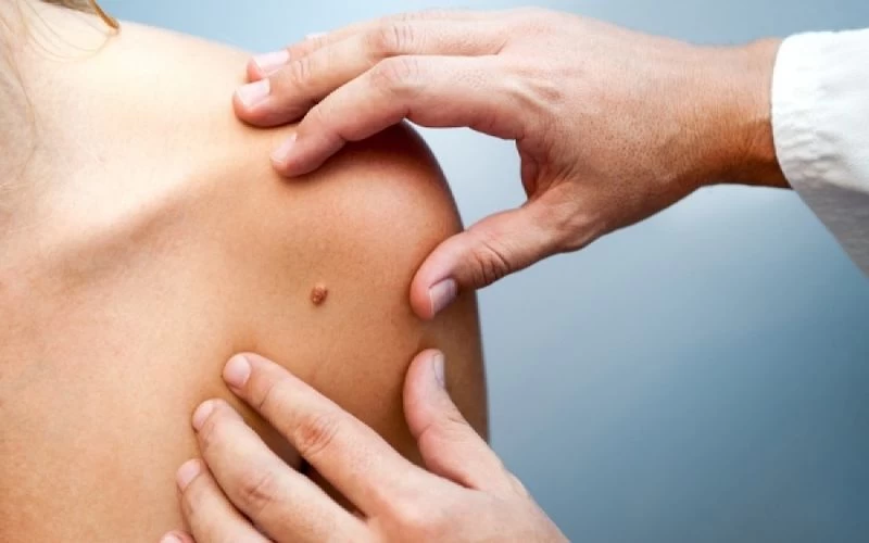 Απλή ελιά ή καρκίνος; Μάθετε να ξεχωρίζετε τις διαφορές